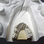 Dental impression cast and  plaster carving enlargment 2008